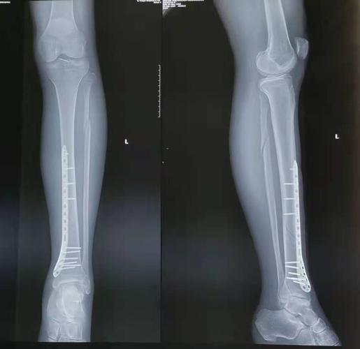 退休 【主诉】 男性,60岁,退休 摔伤致左小腿肿痛伴活动受限7小时入院