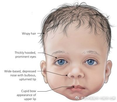 努南综合征(noonan syndrome)本征属原发性睾丸功能减退症的一个类型