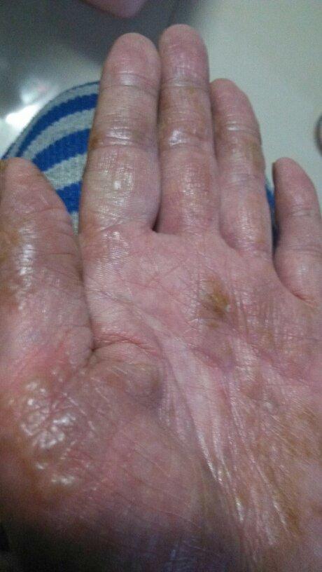 因为老爹刚刚查出了糖尿病,不敢乱