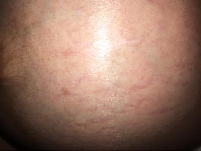 最后一个星期竟然长妊娠纹了