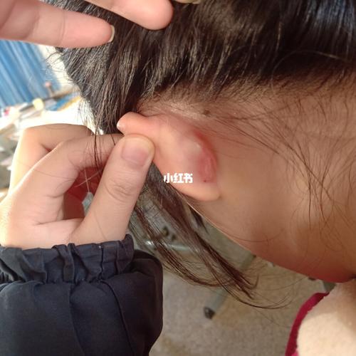 有人知道这是什么吗,是脓疱还是增生啊_耳洞_医疗健康