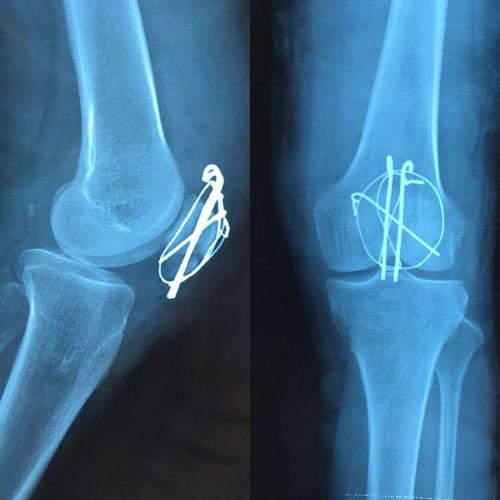 髌骨骨折切开复位克氏针张力带内固定术