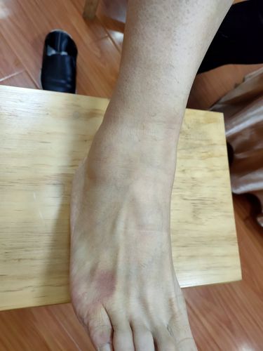 急性扭伤治疗案例