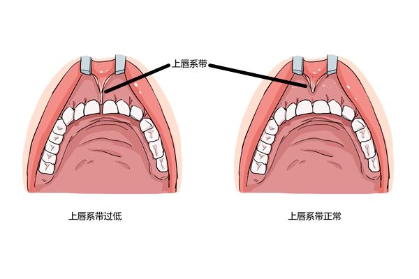 调皮的上唇系带
