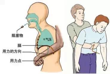 教您海姆立克急救法--抢救气管异物