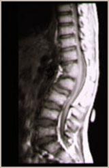 先天性脊柱侧凸