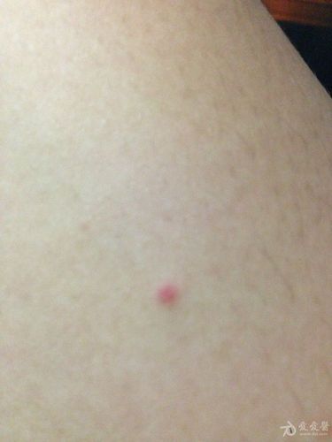 大家来看下这是什么梅毒疹吗.谢啦