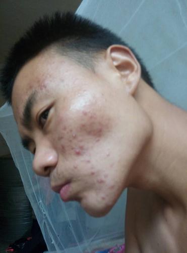 这是痘印还是,痘痘!我在用馥佩套装!以前红的很现在变