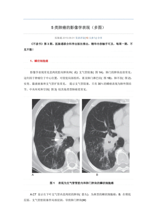 5类肺癌的影像学表现.doc