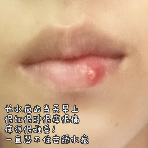 快速治嘴唇炎症长水泡7815唇炎疱疹快快治愈97