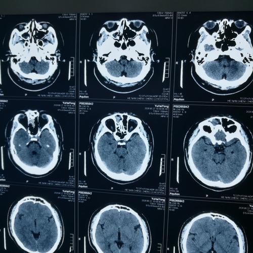 鼻窦ct示右侧鼻窦炎