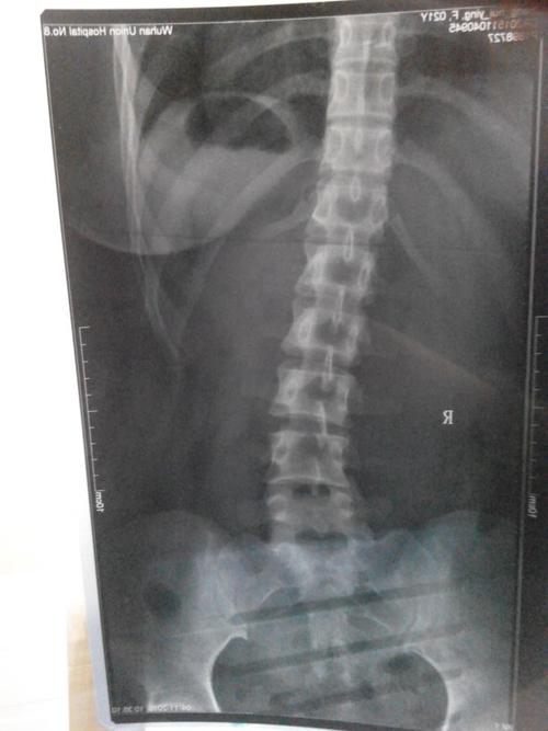 腰椎左侧弯怎么办?我应该怎样矫正?