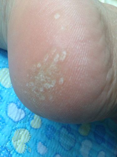 我这是这么了,这是鸡眼吗?后脚跟一按肉很