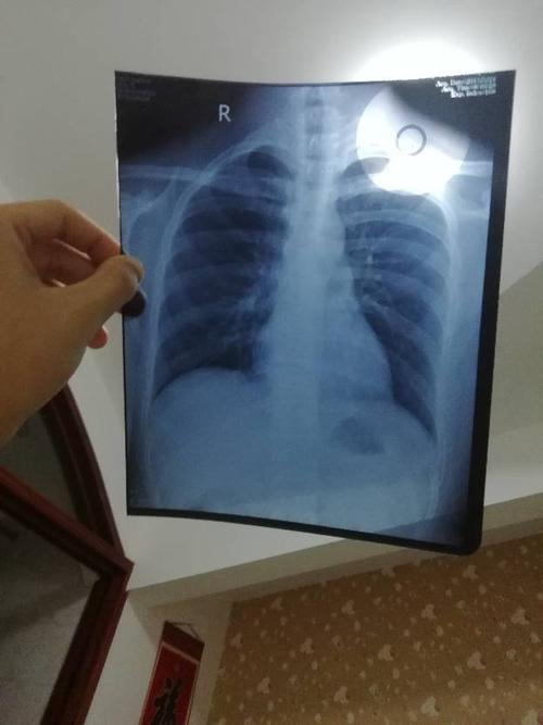 验兵体检x射线胸透没过,拍了个片,请大家帮忙看看什么原因.