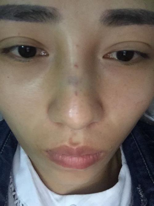 鼻子打了玻尿酸太宽多久时间内就可以打溶解酶?很急.