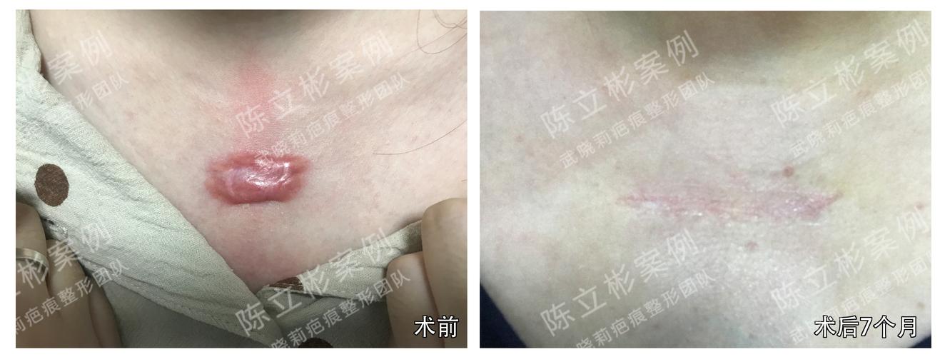 胸部疤痕疙瘩术后7个月复诊记录