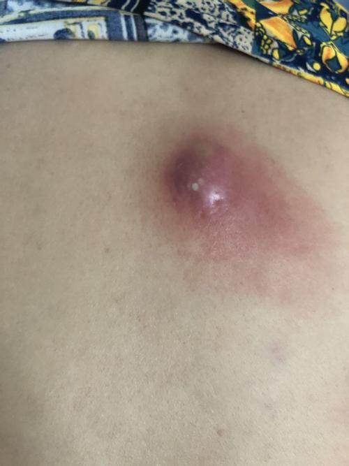 后背长了个这个,是什么?一开始一点,现在长这么大了.