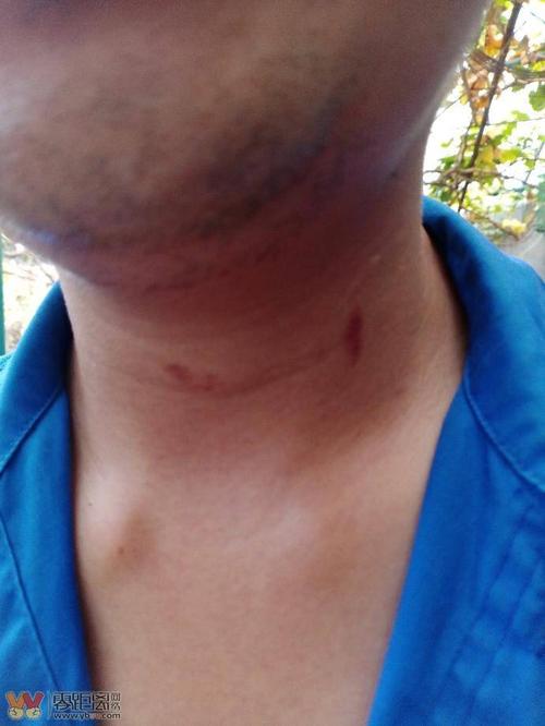 大家帮我看看老公这是不是吻痕我现在每天都要抑郁了