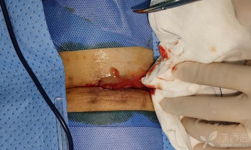 白糖治疗剖腹产伤口感染,一月后伤口红肿疼痛