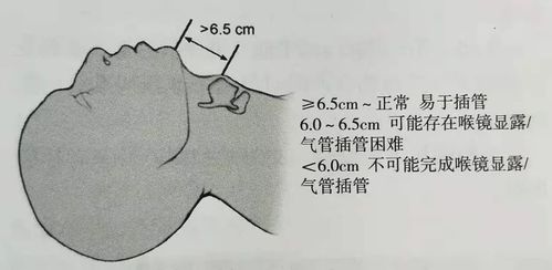 樱桃小嘴,张口受限,门齿间距  3cm(2横指) 有龅牙,小下颏,甲颏距离 6