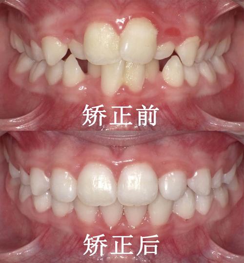 儿童牙齿矫正是在未满15周岁通过正畸或外科手术等方法治疗错颌畸形