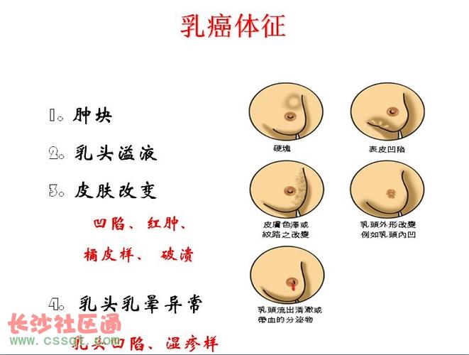 两年前就发现乳腺肿块 工作忙没空体检 今年一查已是乳腺癌晚期