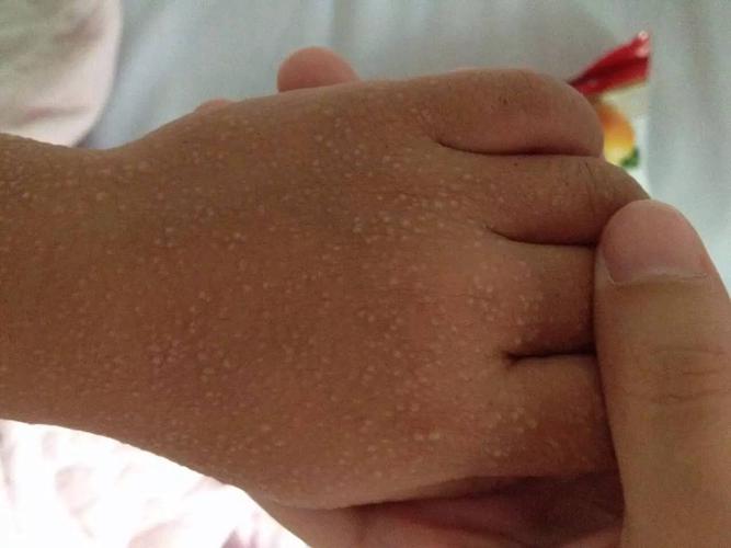 猩红热1例诊疗分析