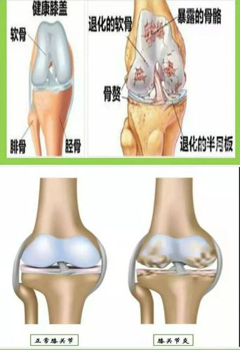 【原创科普】膝关节骨关节病的防治