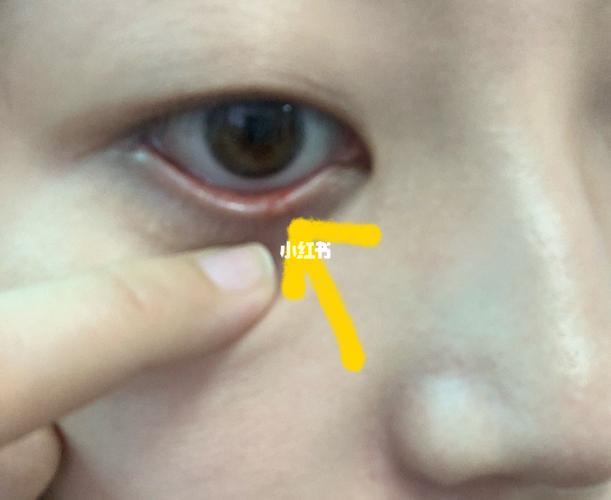 眼睑板堵塞的自我治疗之路._眼药水_眼睛健康_卫生棉