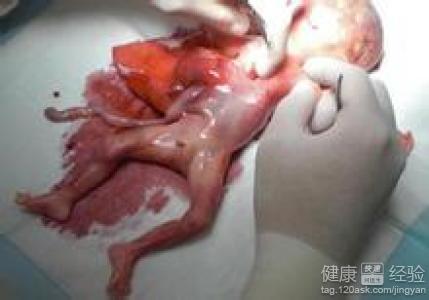 因为引产手术要先给孕妇注射一些药物,目的是使胎儿在孕妇的宫腔里