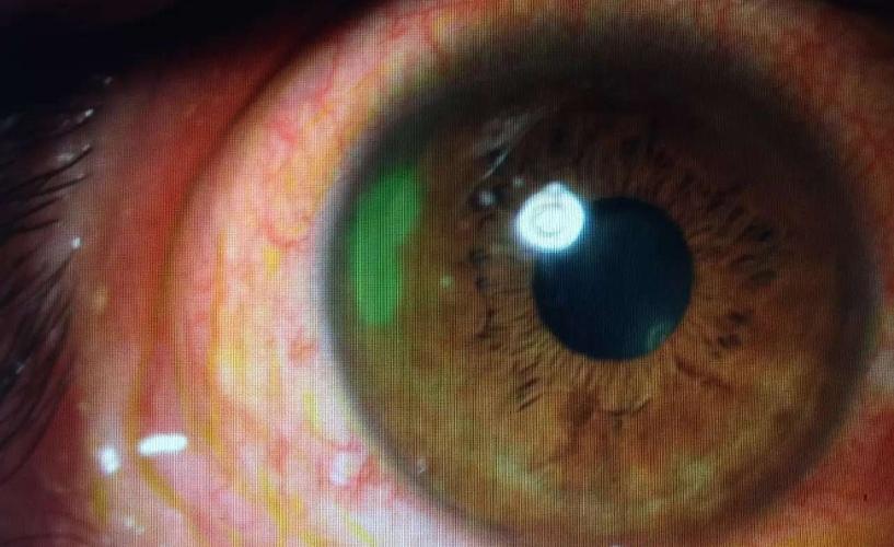 这是角膜上皮缺损的