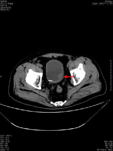 术前ct见膀胱左侧壁占位.