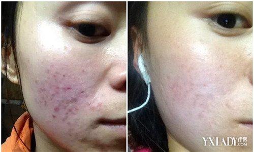 10个淡化痘痕的方法