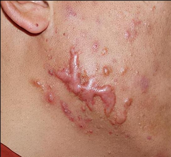 痘痘疤痕疙瘩怎么治疗?|痤疮|粉刺_网易订阅