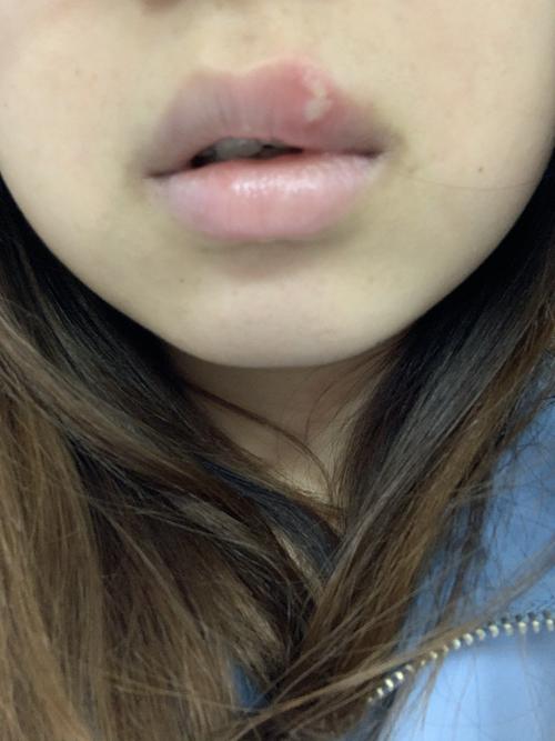突然长的 局部红肿 请问是唇疱疹吗?