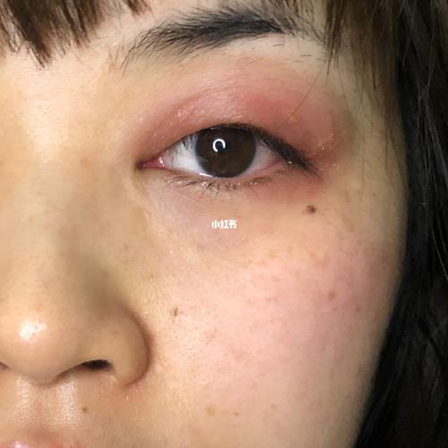 眼皮过敏_过敏_过敏体质_摄影_美妆_个人护理_眼部护理