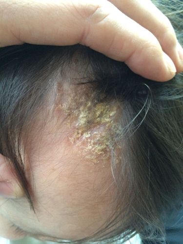 去医院看了有说是抗菌性皮炎的,有说是湿疹的!拿了照片上的这种药