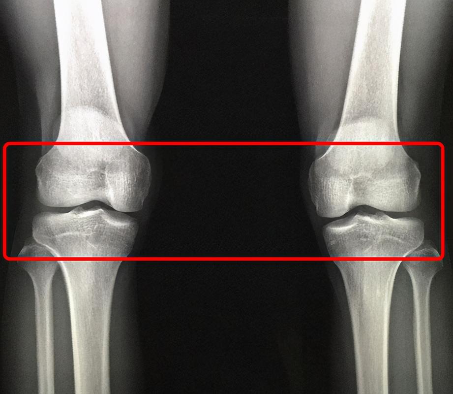 原创14岁男孩身高153,检查后医生:骨骺线已闭合,最多还能长2-3㎝