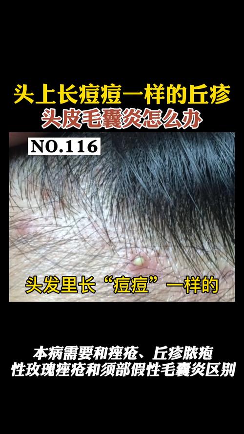 头上长痘痘一样的丘疹,头皮毛囊炎怎么办_毛囊炎_丘疹