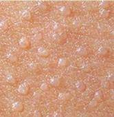 除了粟丘疹和汗管瘤外,青少年面部还好发 扁平疣.