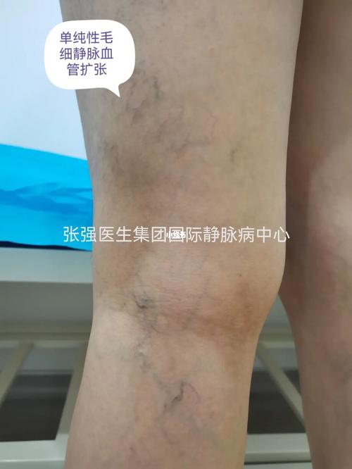 毛细静脉血管扩张在女性中比较多见,主要分为两种类型