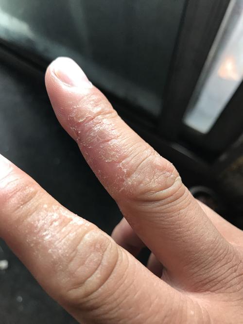 手指关节瘙痒皮肤变硬脱了几层皮都好不了