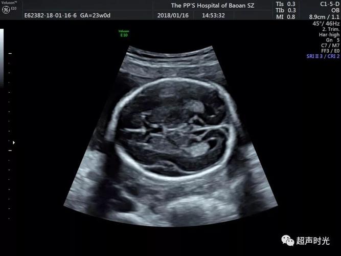 图一 正常侧脑室的标准切面.