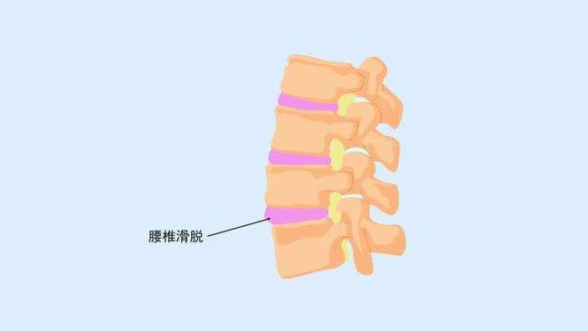 腰椎滑脱是怎么回事