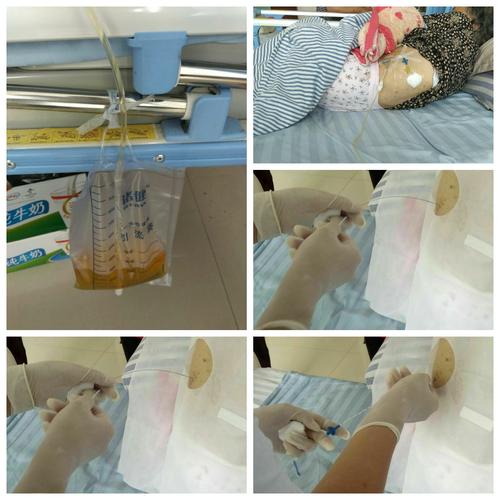 壶关县中医院内科首先引进微创胸,腹腔穿刺置管引流术