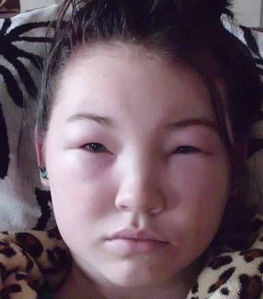 脸部浮肿是什么原因引起的?