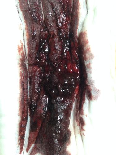 月经血全是黑色的,一坨坨的像黑果冻,为什么会这样?