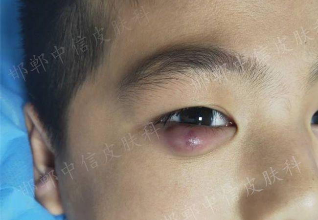 随之而来的疼痛,骚痒等症状,让人感觉不但很痛苦,而且严重影响"观瞻"