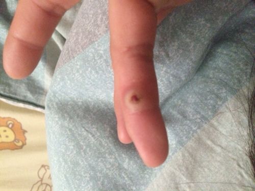 手指之前长了个小红丘 一碰就血流不止 后来去医院检查说是化脓性肉芽