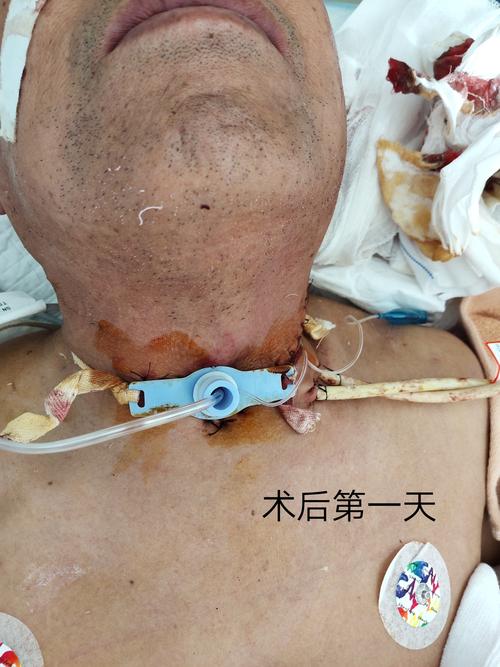 喉部恶性肿瘤(t3n0m0)一例病例报告